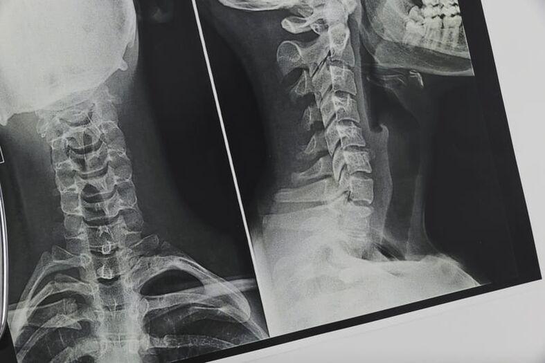 X-ray of the cervical spine affected by osteochondrosis. 
