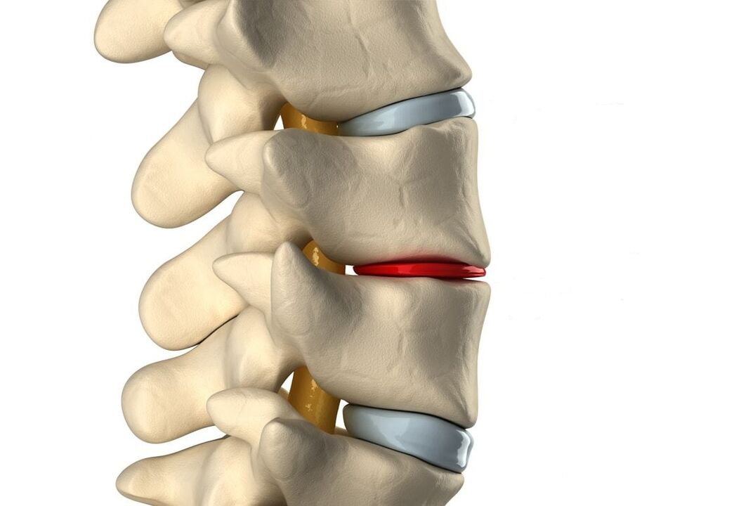 Healthy intervertebral disc (blue) and damaged by thoracic osteochondrosis (red)