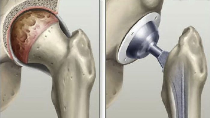 Hip replacement performed in the final stages of coxarthrosis. 