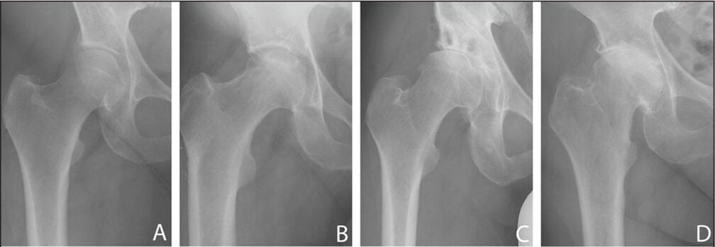Stages of development of osteoarthritis of the hip joint on an x-ray. 