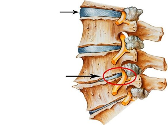 Intervertebral Discos Disorders
