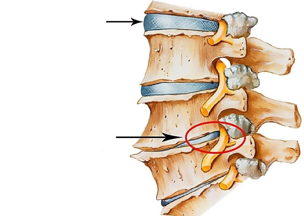 Illustration of healthy and deformed spinal discs.