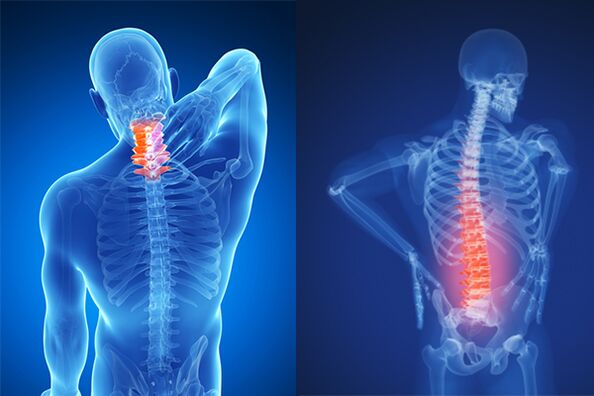 Osteochondrosis of the cervical and lumbar spine.
