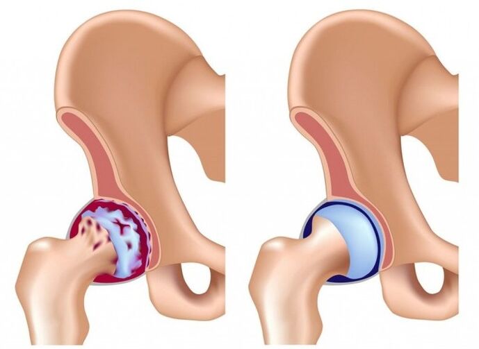 Damage to the hip joint due to osteoarthritis.