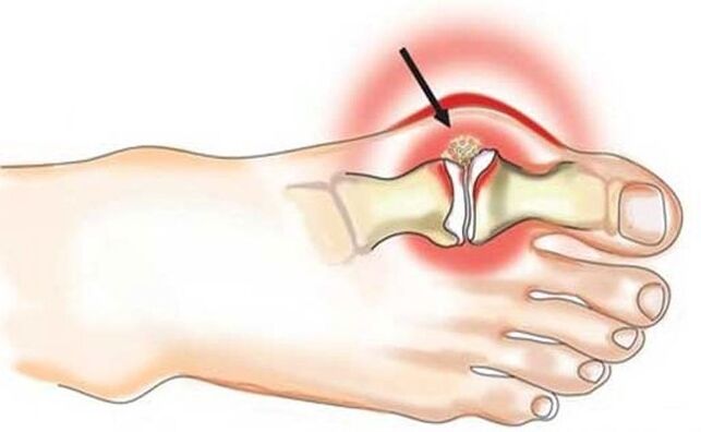 Inflammation of the joint between the big toe and foot due to arthritis.