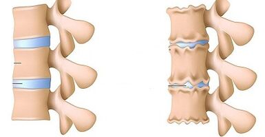 How to recognize the presence of lumbar osteochondrosis