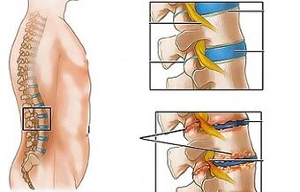The causes of lumbar osteochondrosis